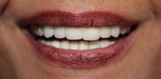 Get Smile Designing Procedures done by Dr. Aastha Chandra at Opal Dental Care Studio in Juhu, Mumbai.