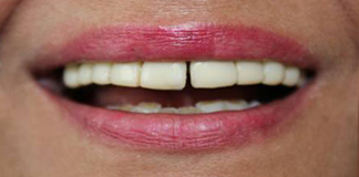 Get Smile Designing Procedures done by Dr. Aastha Chandra at Opal Dental Care Studio in Juhu, Mumbai.