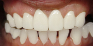 Teeth Extractions Procedure at Opal Dental Care Studio by Dr. Aastha Chandra at Juhu, Mumbai.