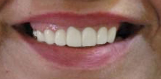 Best and Affordable Dentures at Opal Dental Care Studio in Juhu, Mumbai. - Dr. Aastha Chandra