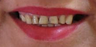 Best and Affordable Dentures at Opal Dental Care Studio in Juhu, Mumbai. - Dr. Aastha Chandra