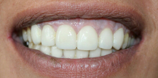 Best Root Canal Treatment by Dr. Aastha Chandra at Opal Dental Care Studio in Juhu, Mumbai.