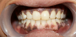 Best Root Canal Treatment by Dr. Aastha Chandra at Opal Dental Care Studio in Juhu, Mumbai.