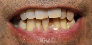 Invisible Aligners at Affordable Rates by Dr. Aastha Chandra in Opal Dental Care Studio