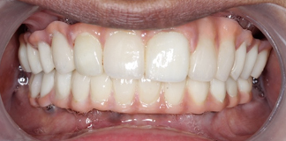 Dental Crown and Bridges at Affordable Rates in Opal Dental Care Studio in Juhu at Mumbai
