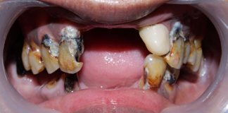 Dental Crown and Bridges at Affordable Rates in Opal Dental Care Studio in Juhu at Mumbai