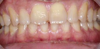 Full Mouth Rehabilitation Procedure at Opal Dental Care Studio in Mumbai - Dr. Aastha Chandra