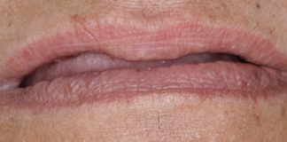 Best Bone Grafting Procedure at Opal Dental Care Studio by Dr. Aastha Chandra in Juhu - Mumbai