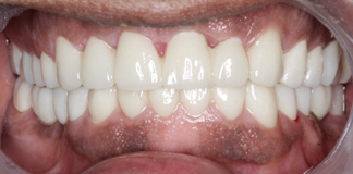 Best and Affordable Dental Filling at Opal Dental Care Studio in Juhu, Mumbai. - Dr. Aastha Chandra