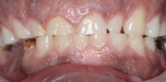 Best and Affordable Dental Filling at Opal Dental Care Studio in Juhu, Mumbai. - Dr. Aastha Chandra