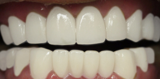 Life Changing Dental Transformation For An Australian Patient By Dr. Aastha Chandra