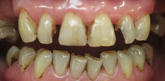 Full Mouth Dental Restoration Using Dental Crowns And Veneers By Dr. Aastha Chandra