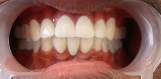 Best Tooth Bonding Procedure at Opal Dental Care Studio in Mumbai - Juhu, by Dr. Aastha Chandra