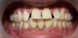 Best Tooth Bonding Procedure at Opal Dental Care Studio in Mumbai - Juhu, by Dr. Aastha Chandra