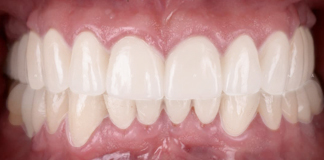 Get Affordable Instant Teeth Whitening Procedures by Dr. Aastha Chandra in Opal Dental Care Studio