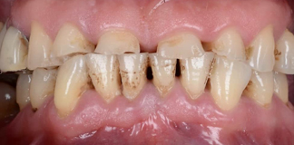 Get Affordable Instant Teeth Whitening Procedures by Dr. Aastha Chandra in Opal Dental Care Studio