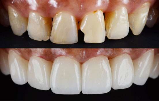 Best Smile Designing Treatment in Mumbai near Juhu