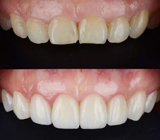 Best Cosmetic Gum Treatment in Mumbai at Opal Dental Care Studio