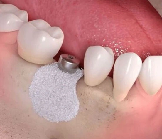 Bone Graft and Sinus Lift in Mumbai at Opal Dental Care Studio