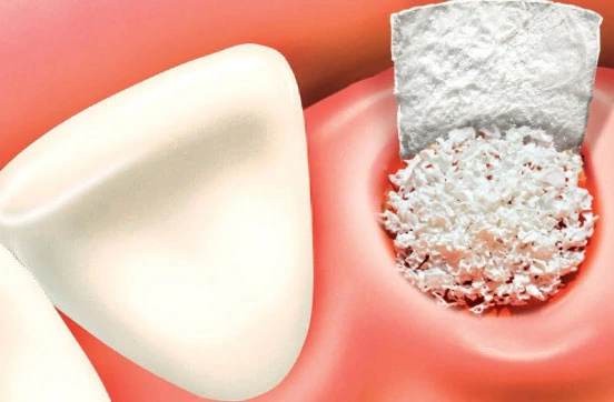 Best Dental Bone Grafting Procedure in Juhu - Mumbai