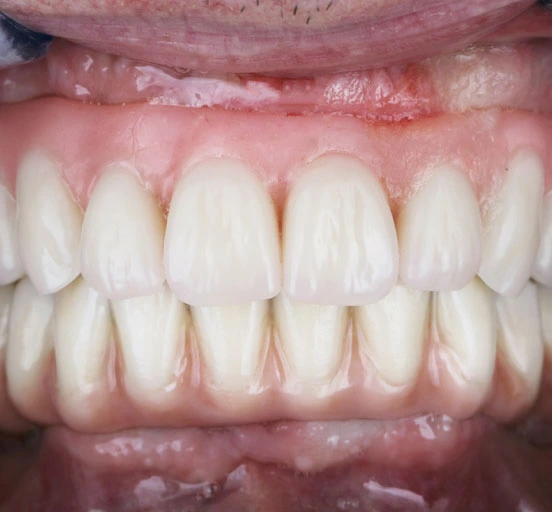 Best Decayed Teeth Treatment in Mumbai - Opal Dental Care Studio