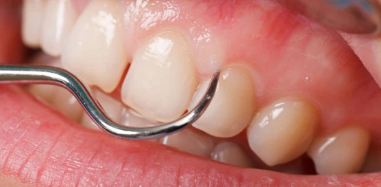 Affordable Gum Treatments in Mumbai - Dr. Aastha Chandra