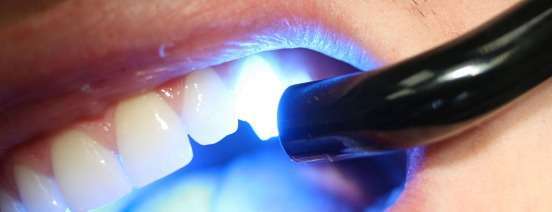 Best Dental Fillings Procedure - Opal Dental Care Studio in Mumbai