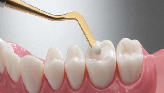 Dental Fillings for Tooth Pain Treatment in Mumbai