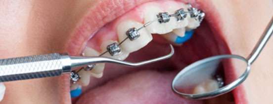 Best Ceramic Braces - Opal Dental Care Studio in Mumbai