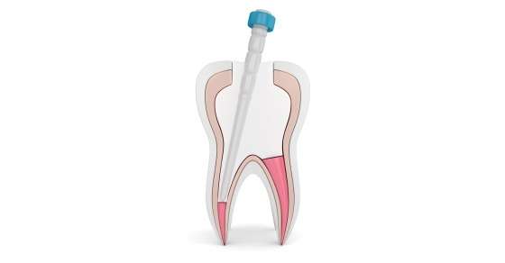 Post and Core Treatment in Mumbai by Dr. Aastha Chandra - Cosmetic Dentist
