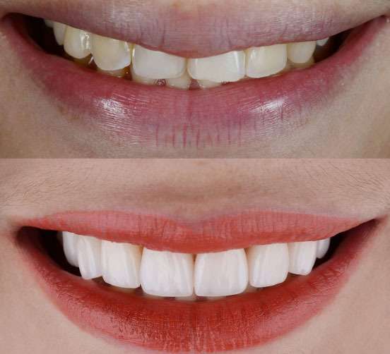 Best Celebrity Smile Makeover Procedure in Mumbai