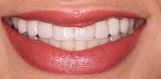 Gorgeous Smile Makeover Trating Cross Bite By Dr. Aastha Chandra At Opal Dental Care Studio
