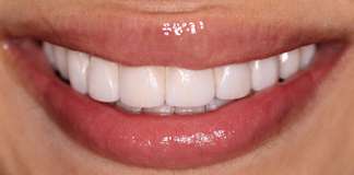 Celebrity Cosmetic Dentist Dr. Aastha Chandra Smile Makeover Using Porcelain Veneers