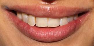 Celebrity Cosmetic Dentist Dr. Aastha Chandra Smile Makeover Using Porcelain Veneers