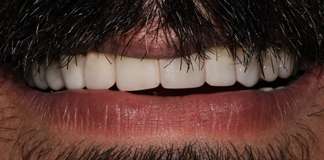 Stained And Yellow Teeth Smile Makeover By Dr. Aastha Chandra At Opal Dental Care Studio
