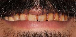 Stained And Yellow Teeth Smile Makeover By Dr. Aastha Chandra At Opal Dental Care Studio