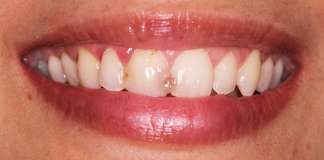 Hollywood Smile By Dr. Aastha Chandra At Opal Dental Care Studio