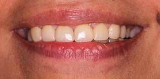 Stained Teeth Treatment By Dr. Aastha Chandra At Opal Dental Care Studio