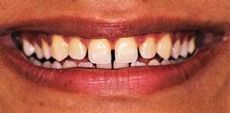 Gaps In Teeth Treatment By Dr. Aastha Chandra At Opal Dental Care Studio