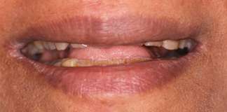 Full Mouth Reconstruction Using Dental Implants And Crowns By Dr. Aastha Chandra At Opal Dental Care Studio