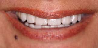 Full Mouth Reconstruction By Dr. Aastha Chandra