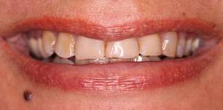 Full Mouth Reconstruction By Dr. Aastha Chandra
