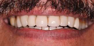 Full Mouth Rehabilitation Using Implants And Veneers By Dr. Aastha Chandra