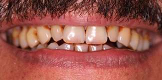 Full Mouth Rehabilitation Using Implants And Veneers By Dr. Aastha Chandra