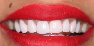 Smile Designing Using Porcelain Veneers By Dr. Aastha Chandra At Opal Dental Care Studio