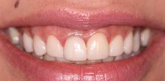 Smile Designing Using Porcelain Veneers By Dr. Aastha Chandra At Opal Dental Care Studio