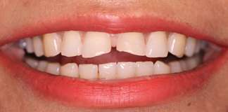 Broken And Chipped Teeth Treatment By Dr. Aastha Chandra At Opal Dental Care Studio