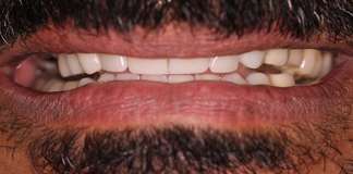 Crown Lengthning By Dr. Aastha Chandra