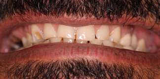 Crown Lengthning By Dr. Aastha Chandra