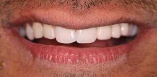Affordable and Best Bone Grafting Procedure by Dr. Aastha Chandra at Opal Dental Care Studio in Mumbai